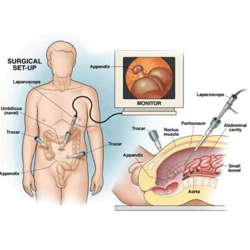 Diagram illustrating a surgical setup for laparoscopic appendectomy, showing instruments, insertion points, and monitor display of the appendix.