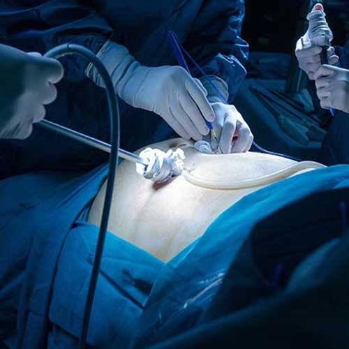 Laparoscopic surgery being performed in a sterile operating room for minimally invasive abdominal procedure.