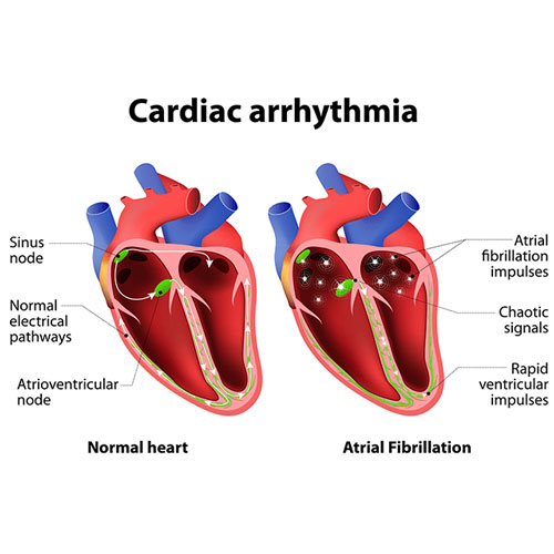 Illustration comparing a normal heart's electrical pathways to those in atrial fibrillation, highlighting chaotic signals and impulses.