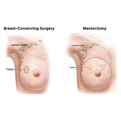 Illustration of laparoscopic sleeve gastrectomy, showing a before-and-after comparison of the stomach and the removed portion.