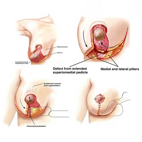 A digital illustration of a fetus inside a womb, with three medical instruments gently accessing the amniotic fluid.