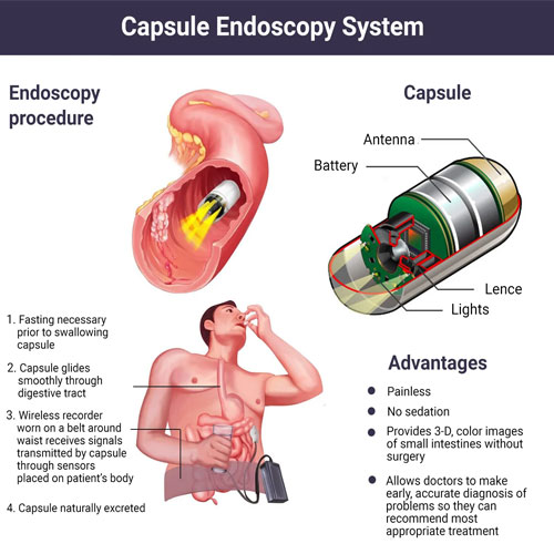 Infographic illustrating the capsule endoscopy system, detailing the procedure, components, and advantages of this non-invasive diagnostic method.