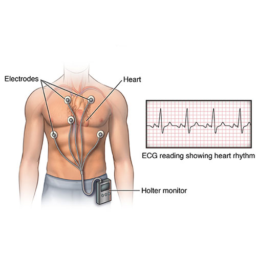Holter monitor connected to chest electrodes for continuous ECG recording – illustration showing heart rhythm monitoring setup