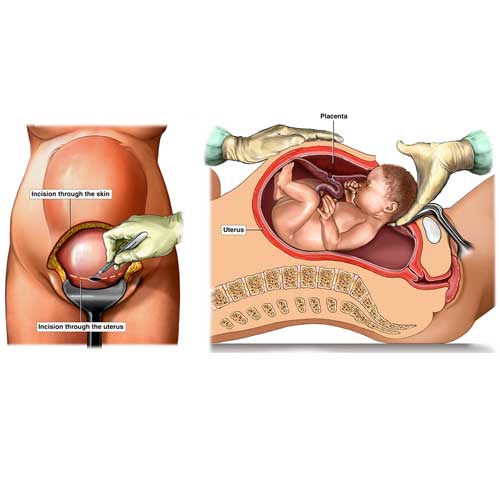Diagram illustrating a surgical setup for laparoscopic appendectomy, showing instruments, insertion points, and monitor display of the appendix.