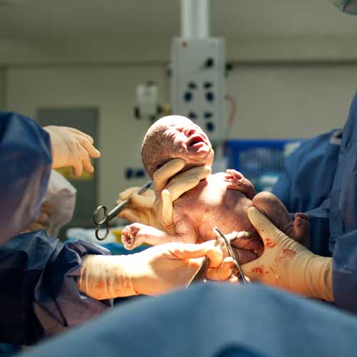 Newborn baby being delivered in a hospital operating room during a cesarean section by medical professionals wearing surgical gloves.