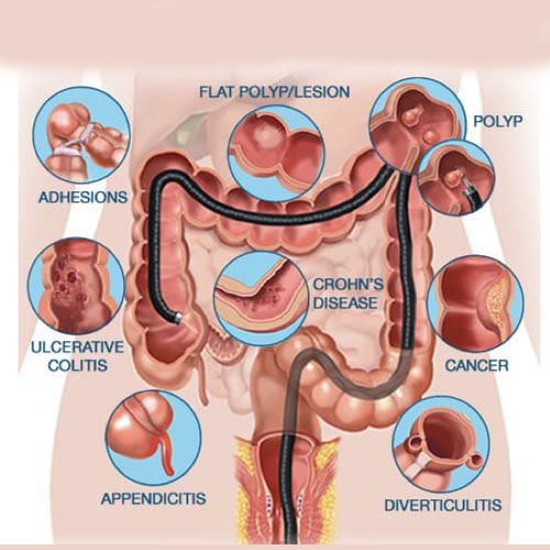 Diagram illustrating various gastrointestinal issues including polyps, Crohn's disease, cancer, and appendicitis with labeled images.