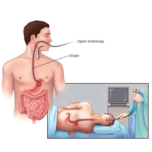 Illustration showing an upper endoscopy procedure, with a flexible scope inserted through the mouth into the esophagus and stomach.