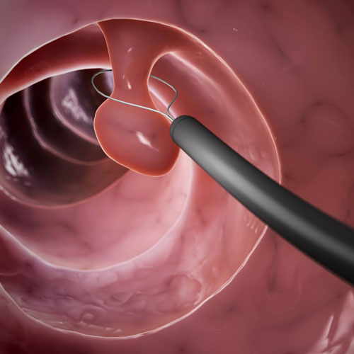 A close-up view of an endoscopic tool navigating through a human intestinal tract, targeting a small polyp for removal.