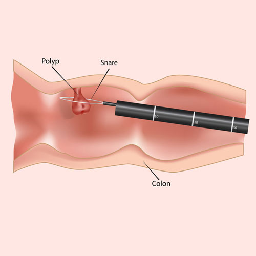 Illustration of a colon with a polyp being removed using a snare, labeled with Polyp, Snare, and Colon.