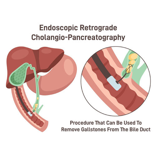 Diagram illustrating Endoscopic Retrograde Cholangiopancreatography (ERCP) for gallstone removal from the bile duct.