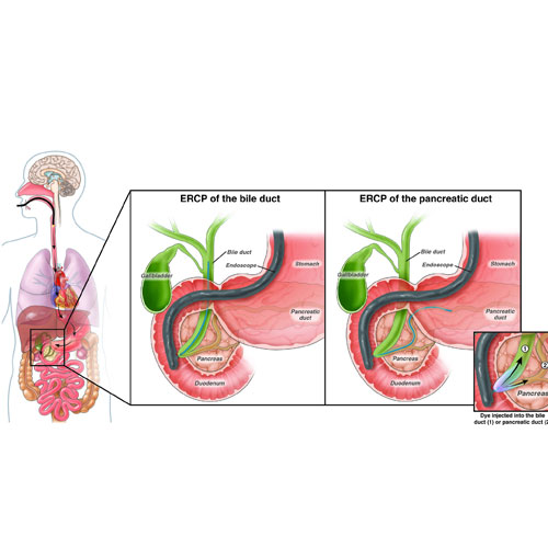 Illustration of ERCP procedures for bile and pancreatic ducts, showing details of the digestive system anatomy and interventions.