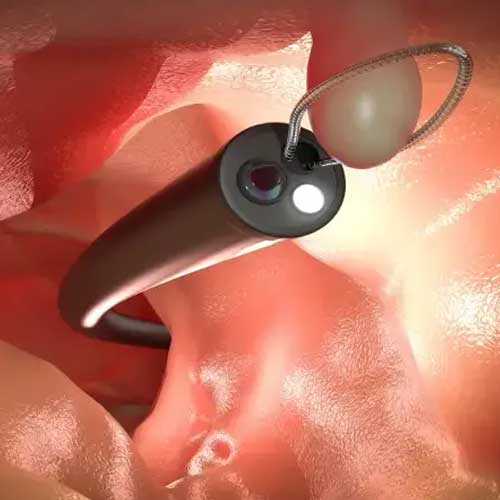 Illustration of laparoscopic sleeve gastrectomy, showing a before-and-after comparison of the stomach and the removed portion.