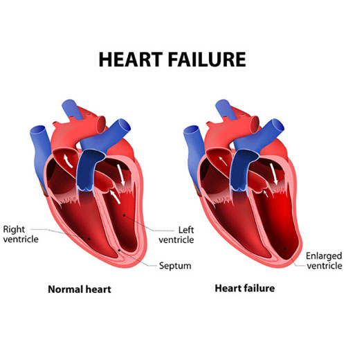 Illustration comparing a normal heart to one with heart failure, highlighting an enlarged left ventricle and altered structure.