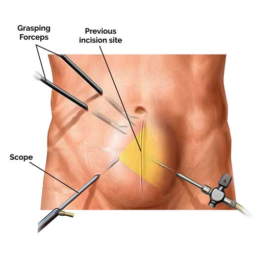 Illustration of a surgical procedure showing grasping forceps, a scope, and a highlighted previous incision site on a abdominal area.