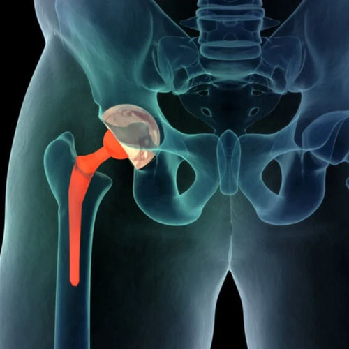 X-ray image of a human pelvis showing a hip joint replacement with a metallic prosthesis in place of the natural femoral head.