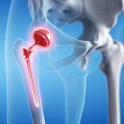 Illustration of a hip joint with a red hip implant, showcasing a surgical procedure in a transparent anatomical view.