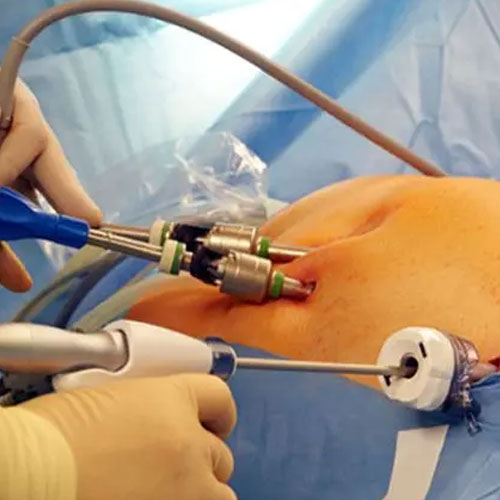Laparoscopic surgery procedure using minimally invasive instruments inserted through abdominal ports