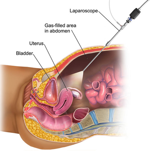 Diagram showing a laparoscopic view of the abdomen, highlighting the uterus, bladder, and gas-filled area.