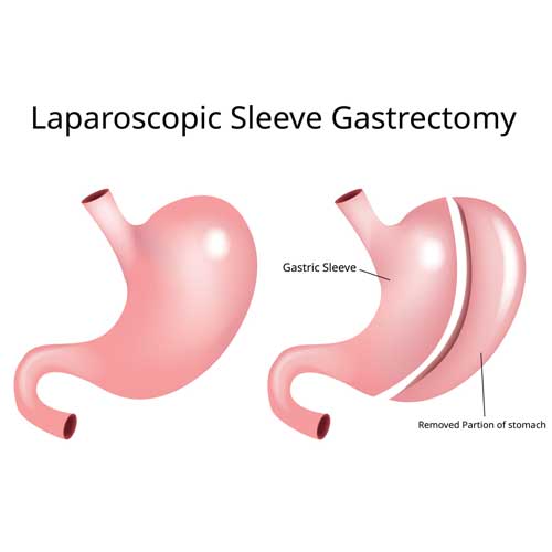 Illustration of laparoscopic sleeve gastrectomy, showing a before-and-after comparison of the stomach and the removed portion.