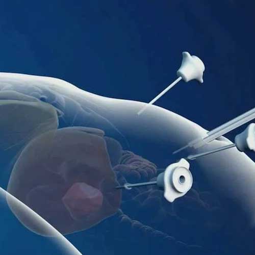 A digital illustration of a fetus inside a womb, with three medical instruments gently accessing the amniotic fluid.