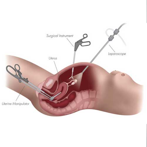 Illustration of a laparoscopic surgical procedure showing instruments like the laparoscope and uterine manipulator inside the uterus.