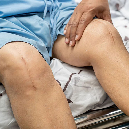 A close-up of a person's knee with visible surgical scars, seated on a bed in a hospital gown, gently resting a hand on their thigh.