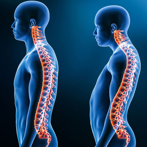 Side-by-side comparison of two human figures showing different spinal alignments, illuminated to highlight the vertebral structure.
