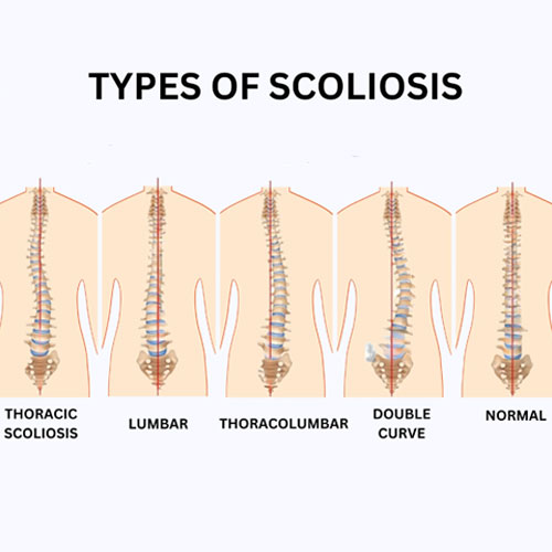 Illustration showing five types of scoliosis: thoracic, lumbar, thoracolumbar, double curve, and a normal spine for comparison.