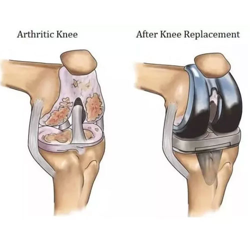 Illustration comparing an arthritic knee with damage to a healthy knee post-replacement, showing improvement in joint structure.