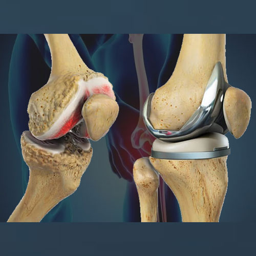 Illustration comparing a damaged knee joint with arthritis (left) to a knee replacement implant (right).