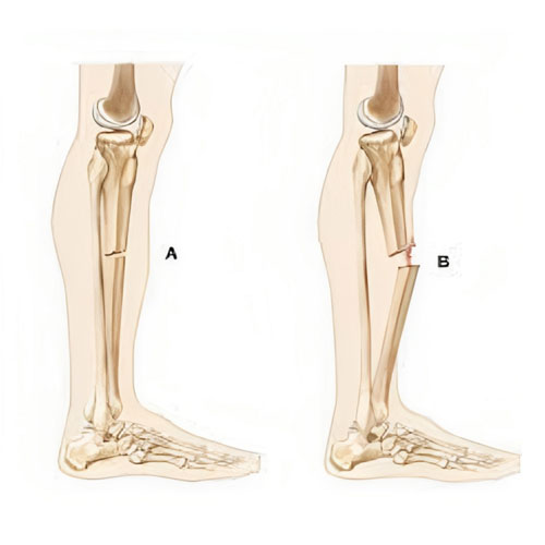 Anatomical illustration depicting the human leg bones, highlighting a fracture in the tibia on the right.