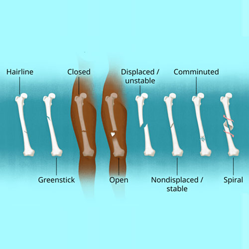 Illustration of various types of bone fractures: hairline, closed, greenstick, open, displaced/unstable, comminuted, nondisplaced/stable, and spiral.