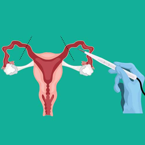 Illustration of a uterus with a hand holding a medical instrument for a procedure, depicted on a teal background.