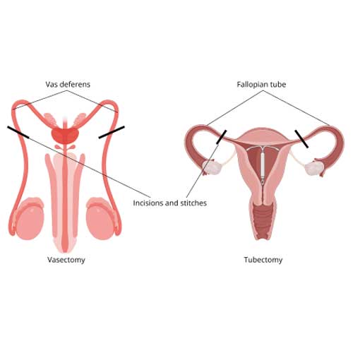 Illustration showing male vasectomy and female tubectomy procedures, with labels for vas deferens, fallopian tube, incisions, and stitches.