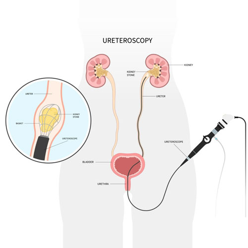 Illustration of ureteroscopy, showing kidneys, ureters, bladder, and a ureteroscope with a focus on kidney stones treatment.