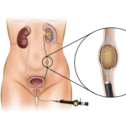 Illustration of a urinary system with renal stones, showing a kidney, bladder, and a medical instrument used for stone removal.