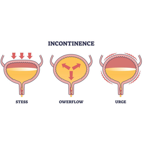 Illustration of bladder incontinence types: Stress, Overflow, and Urge, showing fluid dynamics in each scenario.